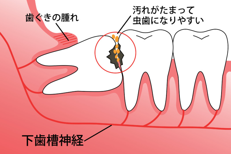 親知らずは抜歯すべき 痛みの原因と歯医者が行う治療とは 医院ブログ 永田歯科医院 立川市の砂川七番駅から0分 駐車場完備