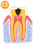 虫歯C2