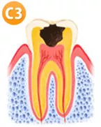 虫歯C2