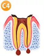 虫歯C2