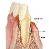 歯周病