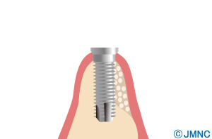 implant_19-3