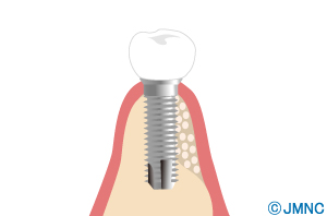 implant_19-4