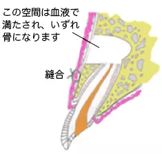 歯根端切除_3